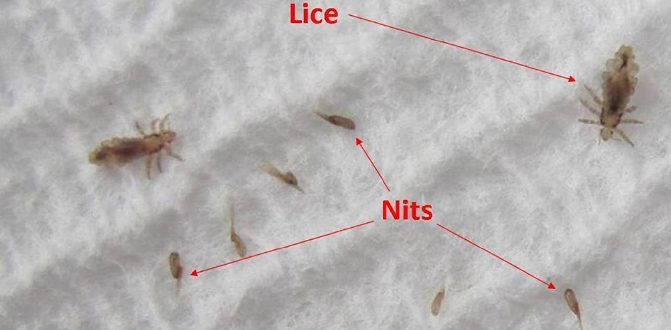 How to Identify the Signs of a Lice Infestation Early