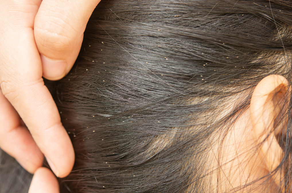 Step-by-Step Guide Head Lice Treatment, Nashville