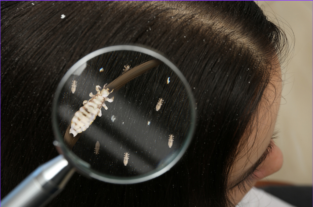 Lice Love Clean Hair Too | Your Natural Treatment Guide